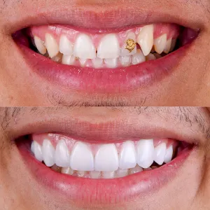 veneers dental