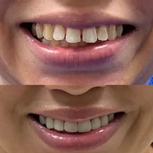 veneers treatment