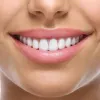 veneers treatment